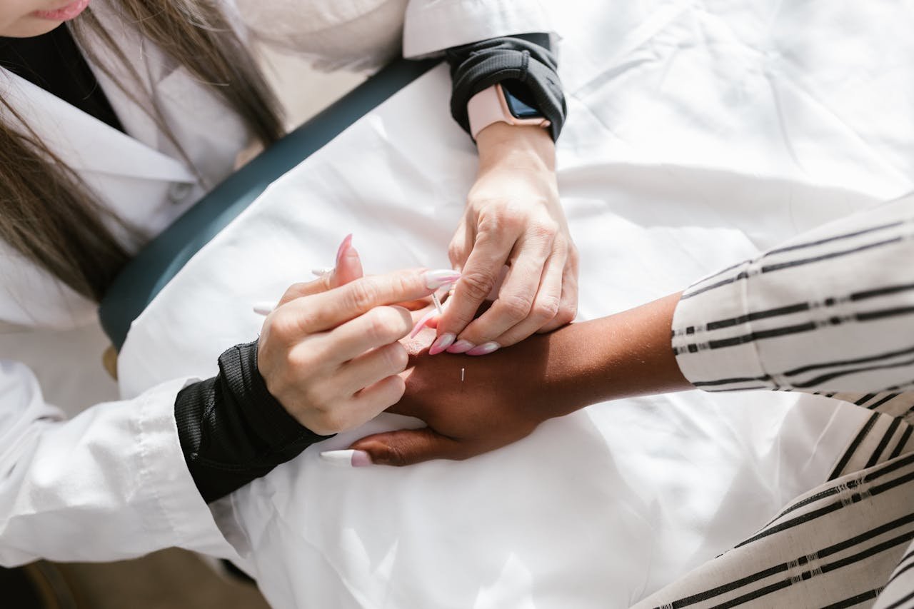 Close-up of a professional performing acupuncture therapy on a clients hand for wellness.